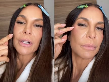 Ivete Sangalo atualiza recuperação após cirurgia